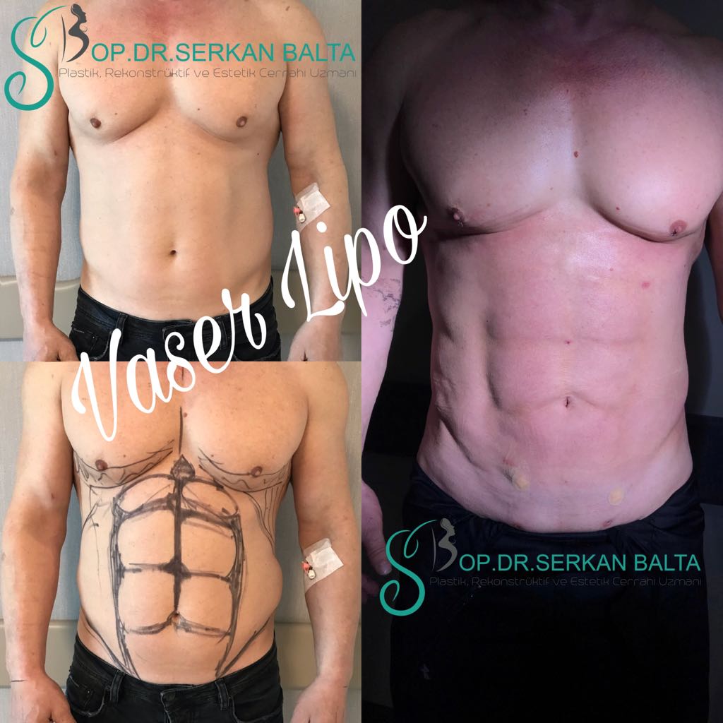 ABS Turkey